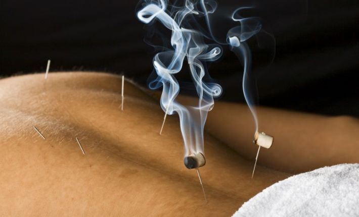 Acupuncture with moxa on needles